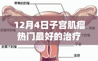 12月4日最新热门子宫肌瘤治疗方法全面评测及最佳疗法探讨