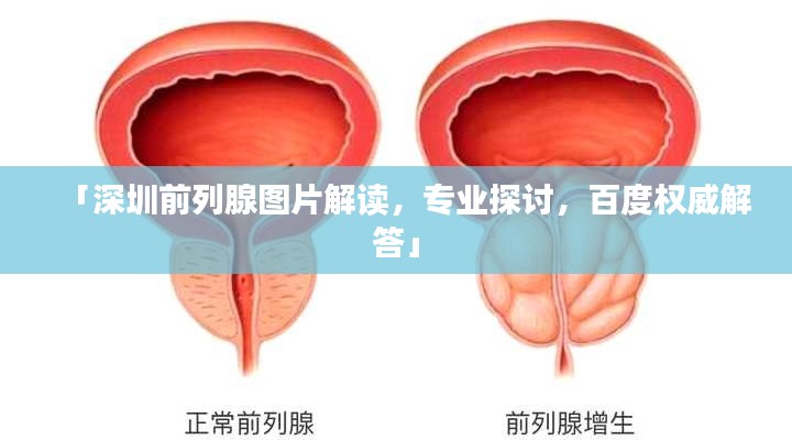 「深圳前列腺图片解读，专业探讨，百度权威解答」